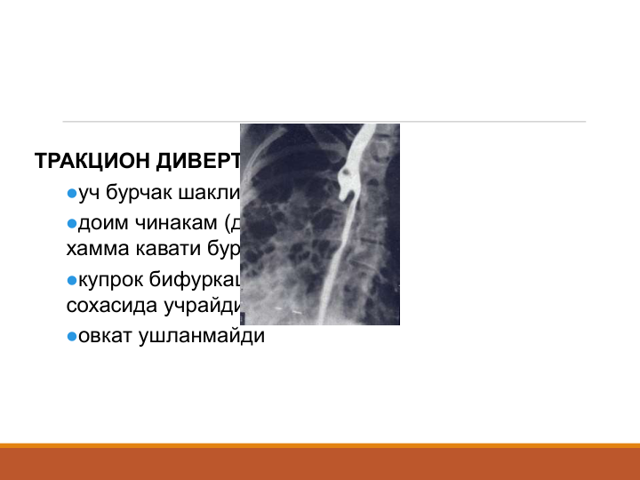ТРАКЦИОН ДИВЕРТИКУЛ
уч бурчак шаклида,  
доим чинакам (деворни 
хамма кавати буртади)
купрок бифуркация 
сохасида учрайди, 
овкат ушланмайди

