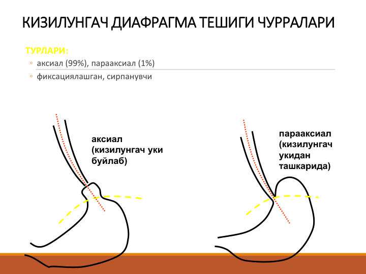 КИЗИЛУНГАЧ ДИАФРАГМА ТЕШИГИ ЧУРРАЛАРИ 
ТУРЛАРИ:
◦ аксиал (99%), парааксиал (1%) 
◦ фиксациялашган, сирпанувчи
аксиал 
(кизилунгач уки 
буйлаб)
парааксиал 
(кизилунгач 
укидан 
ташкарида)
