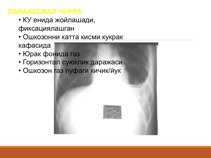 ПАРААКСИАЛ ЧУРРА
• КУ енида жойлашади, 
фиксациялашган
• Ошкозонни катта кисми кукрак 
кафасида
• Юрак фонида газ 
• Горизонтал суюклик даражаси
• Ошкозон газ пуфаги кичик/йук   
