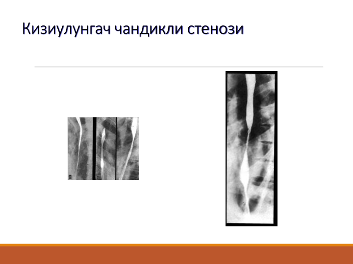 Кизиулунгач чандикли стенози
