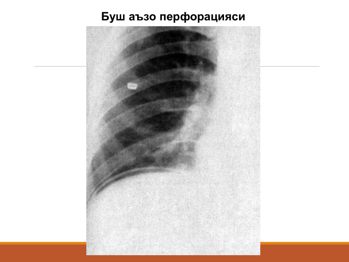 Буш аъзо перфорацияси
