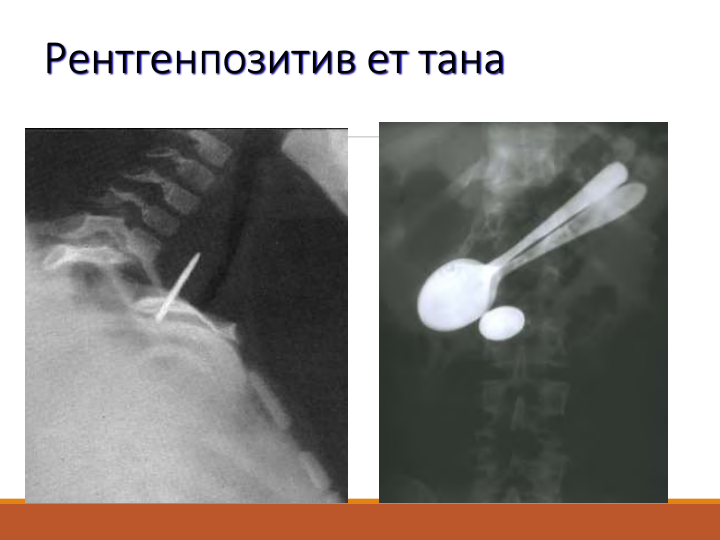 Рентгенпозитив ет тана
