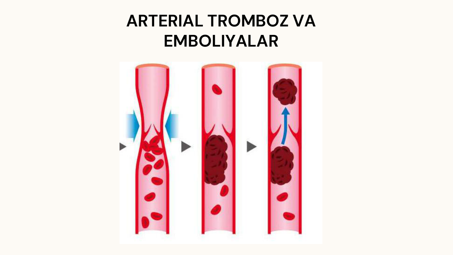 ARTERIAL TROMBOZ VA 
EMBOLIYALAR
