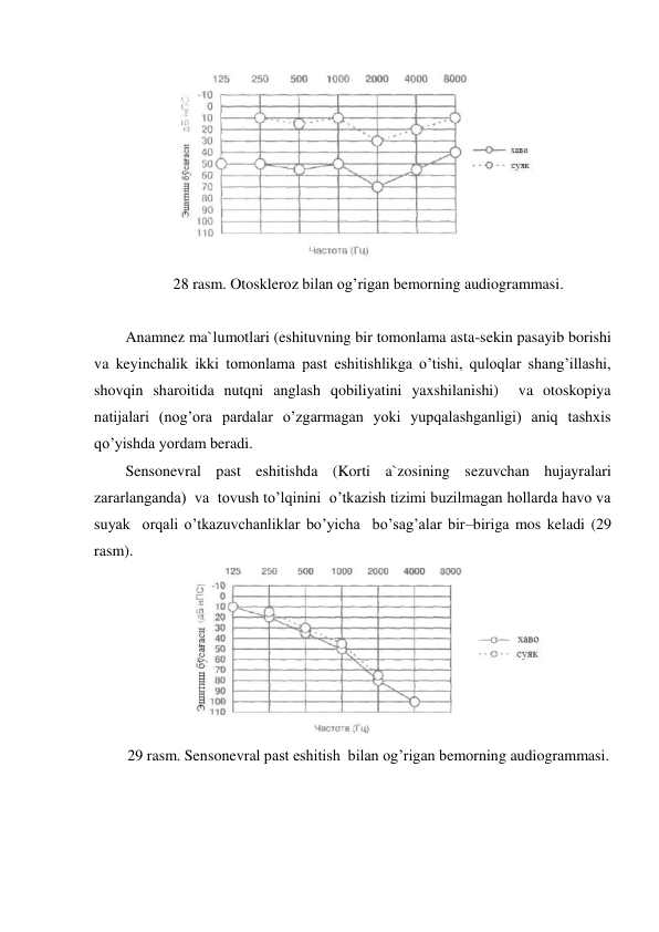  
28 rasm. Otoskleroz bilan og’rigan bemorning audiogrammasi. 
 
Anamnez ma`lumotlari (eshituvning bir tomonlama asta-sekin pasayib borishi 
va keyinchalik ikki tomonlama past eshitishlikga o’tishi, quloqlar shang’illashi, 
shovqin sharoitida nutqni anglash qobiliyatini yaxshilanishi)  va otoskopiya 
natijalari (nog’ora pardalar o’zgarmagan yoki yupqalashganligi) aniq tashxis 
qo’yishda yordam beradi.  
Sensonevral past eshitishda (Korti a`zosining sezuvchan hujayralari 
zararlanganda)  va  tovush to’lqinini  o’tkazish tizimi buzilmagan hollarda havo va 
suyak  orqali o’tkazuvchanliklar bo’yicha  bo’sag’alar bir–biriga mos keladi (29 
rasm). 
 
29 rasm. Sensonevral past eshitish  bilan og’rigan bemorning audiogrammasi. 
 
