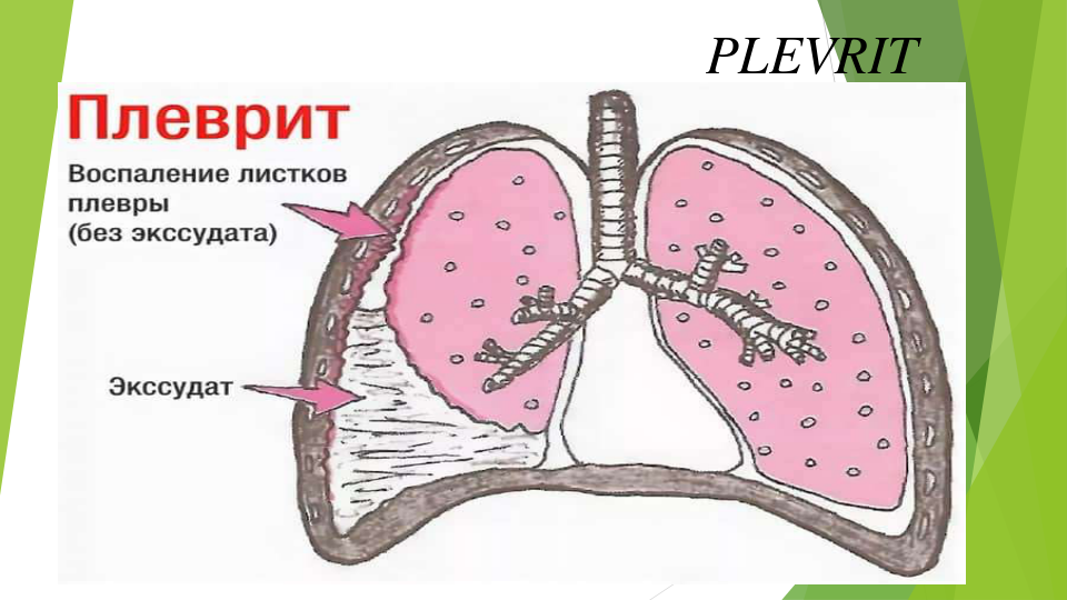 PLEVRIT
