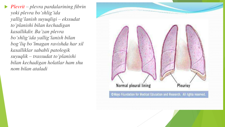  Plevrit – plevra pardalarining fibrin 
yoki plevra bo‘shlig‘ida
yallig‘lanish suyuqligi – ekssudat
to‘planishi bilan kechadigan
kasallikdir. Ba’zan plevra
bo‘shlig‘ida yallig‘lanish bilan
bog‘liq bo‘lmagan ravishda har xil
kasalliklar sababli patologik
suyuqlik – trassudat to‘planishi
bilan kechadigan holatlar ham shu
nom bilan ataladi
