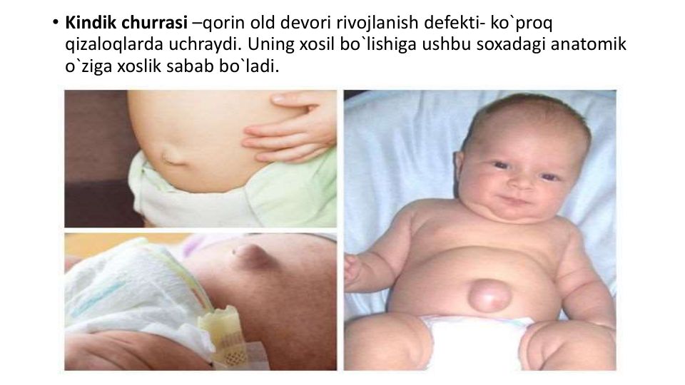 • Kindik churrasi –qorin old devori rivojlanish defekti- ko`proq 
qizaloqlarda uchraydi. Uning xosil bo`lishiga ushbu soxadagi anatomik 
o`ziga xoslik sabab bo`ladi. 
