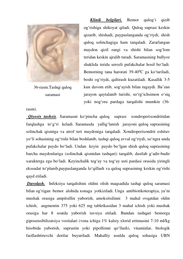       Klinik 
belgilari. 
Bemor 
qulog‘i 
qizib 
og‘rishiga shikoyat qiladi. Quloq suprasi keskin 
qizarib, shishadi, paypaslanganda og‘riydi, shish 
quloq solinchagiga ham tarqaladi. Zararlangan 
maydon qizil rangi va shishi bilan sog‘lom 
teridan keskin ajralib turadi. Saramasning bullyoz 
shaklida terida serozli pufakchalar hosil bo‘ladi. 
Bemorning tana harorati 39-400C ga ko‘tariladi, 
boshi og‘riydi, qaltirash kuzatiladi. Kasallik 3-5 
kun davom etib, sog‘ayish bilan tugaydi. Ba’zan 
jarayon qaytalanib turishi, so‘rg‘ichsimon o‘siq 
yoki nog‘ora pardaga tarqalishi mumkin (36-
rasm). 
  Qiyosiy tashxis. Saramasni ko‘pincha quloq  suprasi  xondroperixondritidan  
farqlashga  to‘g‘ri  keladi. Saramasda  yallig‘lanish  jarayoni quloq suprasining 
solinchak qismiga va atrof teri maydoniga tarqaladi. Xondroperixondrit eshituv 
yo‘li sohasining og‘rishi bilan boshlanib, tashqi quloq avval og‘riydi, so‘ngra unda 
pufakchalar paydo bo‘ladi. Undan  keyin  paydo bo‘lgan shish quloq suprasining 
barcha maydonlariga (solinchak qismidan tashqari) tarqalib, dastlab g‘adir-budir 
xarakterga ega bo‘ladi. Keyinchalik tog‘ay va tog‘ay usti pardasi orasida yiringli 
ekssudat to‘planib,paypaslanganda lo‘qillash va quloq suprasining keskin og‘rishi 
qayd etiladi. 
 Davolash.  Infeksiya tarqalishini oldini olish maqsadida tashqi quloq saramasi 
bilan og‘rigan  bemor  alohida xonaga  yotkiziladi. Unga  antibiotikoterapiya, ya’ni 
mushak orasiga ampitsillin yuborish, amoksitsilinni  3 mahal ovqatdan oldin 
ichish,  augmentin 375 yoki 625 mg tabletkasidan 3 mahal ichish yoki mushak 
orasiga har 8 soatda yuborish tavsiya etiladi. Bundan tashqari bemorga 
giposensibilizatsiya vositalari (vena ichiga 1% kalsiy xlorid eritmasini 7-10 ml/kg 
hisobida yuborish, suprastin yoki pipolfenni qo‘llash), vitaminlar, biologik 
faollashtiruvchi dorilar buyuriladi. Mahalliy usulda quloq sohasiga UBN 
 
36-rasm.Tashqi quloq 
saramasi 
