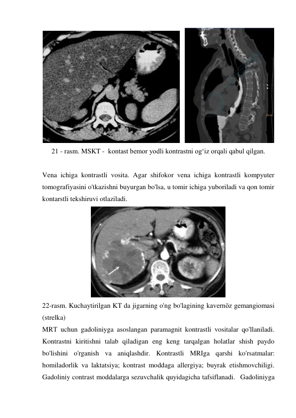    
 
21 - rasm. MSKT -  kontast bemor yodli kontrastni og‘iz orqali qabul qilgan. 
 
Vena ichiga kontrastli vosita. Agar shifokor vena ichiga kontrastli kompyuter 
tomografiyasini o'tkazishni buyurgan bo'lsa, u tomir ichiga yuboriladi va qon tomir 
kontarstli tekshiruvi otlaziladi.  
 
22-rasm. Kuchaytirilgan KT da jigarning o'ng bo'lagining kavernöz gemangiomasi 
(strelka) 
MRТ uchun gadoliniyga asoslangan paramagnit kontrastli vositalar qo'llaniladi. 
Kontrastni kiritishni talab qiladigan eng keng tarqalgan holatlar shish paydo 
bo'lishini o'rganish va aniqlashdir. Kontrastli MRIga qarshi ko'rsatmalar: 
homiladorlik va laktatsiya; kontrast moddaga allergiya; buyrak etishmovchiligi. 
Gadoliniy contrast moddalarga sezuvchalik quyidagicha tafsiflanadi.  Gadoliniyga 
