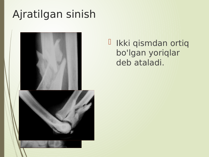 Ajratilgan sinish
 Ikki qismdan ortiq 
bo'lgan yoriqlar 
deb ataladi.
