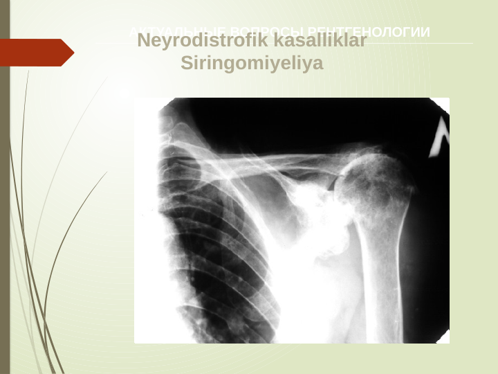 АКТУАЛЬНЫЕ ВОПРОСЫ РЕНТГЕНОЛОГИИ
Neyrodistrofik kasalliklar
Siringomiyeliya

