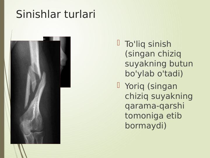  Sinishlar turlari
 To'liq sinish 
(singan chiziq 
suyakning butun 
bo'ylab o'tadi)
 Yoriq (singan 
chiziq suyakning 
qarama-qarshi 
tomoniga etib 
bormaydi)
