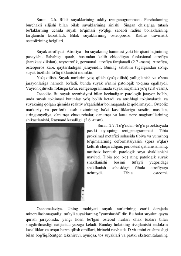 Surat  2.6. Bilak suyaklarining oddiy rentgenogrammasi. Parchalarning 
burchakli siljishi bilan bilak suyaklarining sinishi. Singan chizig'iga tutash 
bo'laklarning uchida suyak to'qimasi yo'qligi sababli radius bo'laklarining 
farqlanishi kuzatiladi. Bilak suyaklarining osteoporozi. Radius travmatik 
osteolizining belgilari. 
 
Suyak atrofiyasi. Atrofiya - bu suyakning hammasi yoki bir qismi hajmining 
pasayishi. Sababiga qarab, bosimdan kelib chiqadigan funktsional atrofiya 
(harakatsizlikdan), neyrotrofik, gormonal  atrofiya farqlanadi (2.7 -rasm). Atrofiya, 
osteoporoz kabi, qaytariladigan jarayondir. Buning sababini tugatgandan so'ng, 
suyak tuzilishi to'liq tiklanishi mumkin. 
Yo'q qilish. Suyak nurlarini yo'q qilish (yo'q qilish) yallig'lanish va o'sma 
jarayonlariga hamroh bo'ladi, bunda suyak o'rnini patologik to'qima egallaydi. 
Vayron qiluvchi fokusga ko'ra, rentgenogrammada suyak naqshlari yo'q (2.8 -rasm). 
Osteoliz. Bu suyak rezorbsiyasi bilan kechadigan patologik jarayon bo'lib, 
unda suyak to'qimasi butunlay yo'q bo'lib ketadi va atrofdagi to'qimalarda va 
suyakning qolgan qismida reaktiv o'zgarishlar bo'lmaganda iz qoldirmaydi. Osteoliz 
markaziy va periferik asab tizimining ba'zi kasalliklariga xosdir, masalan, 
siringomyeliya, o'murtqa chuqurchalar, o'murtqa va katta nerv magistrallarining 
shikastlanishi, Raynaud kasalligi. (2.6 -rasm). 
Surat . 2.7. To'g'ridan -to'g'ri proektsiyada 
pastki oyoqning rentgenogrammasi. Tibia 
proksimal metafizi sohasida tibiya va yumshoq 
to'qimalarning deformatsiyasini (qora o'qlar) 
keltirib chiqaradigan, periosteal qatlamsiz, aniq, 
tartibsiz konturli patologik soya shakllanishi 
mavjud. Tibia (oq o'q) ning patologik suyak 
shakllanishi 
bosimi 
tufayli 
yuqoridagi 
shakllanish 
sohasidagi 
fibula 
atrofiyaga 
uchraydi. 
Tibia 
osteomi. 
 
Osteomalaziya. 
Uning 
mohiyati 
suyak 
nurlarining 
etarli 
darajada 
minerallashmaganligi tufayli suyaklarning "yumshashi" dir. Bu holat suyakni qayta 
qurish jarayonida, yangi hosil bo'lgan osteoid nurlari ohak tuzlari bilan 
singdirilmasligi natijasida yuzaga keladi. Bunday holatning rivojlanishi endokrin 
kasalliklar va ovqat hazm qilish omillari, birinchi navbatda D vitamini etishmasligi 
bilan bog'liq.Rentgen tekshiruvi, ayniqsa, tos suyaklari va pastki ekstremitalarning 
