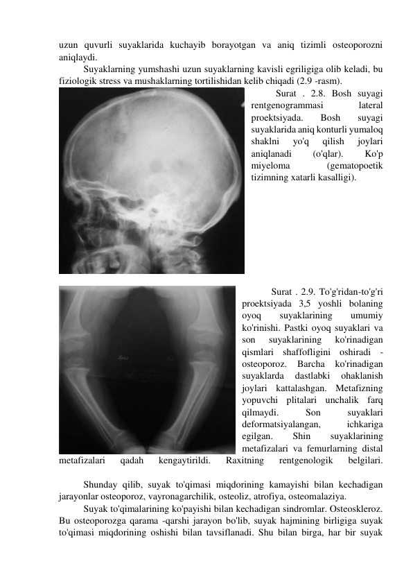 uzun quvurli suyaklarida kuchayib borayotgan va aniq tizimli osteoporozni 
aniqlaydi. 
Suyaklarning yumshashi uzun suyaklarning kavisli egriligiga olib keladi, bu 
fiziologik stress va mushaklarning tortilishidan kelib chiqadi (2.9 -rasm). 
Surat . 2.8. Bosh suyagi 
rentgenogrammasi 
lateral 
proektsiyada. 
Bosh 
suyagi 
suyaklarida aniq konturli yumaloq 
shaklni 
yo'q 
qilish 
joylari 
aniqlanadi 
(o'qlar). 
Ko'p 
miyeloma 
(gematopoetik 
tizimning xatarli kasalligi). 
 
 
  Surat . 2.9. To'g'ridan-to'g'ri 
proektsiyada 3,5 yoshli bolaning 
oyoq 
suyaklarining 
umumiy 
ko'rinishi. Pastki oyoq suyaklari va 
son 
suyaklarining 
ko'rinadigan 
qismlari shaffofligini oshiradi - 
osteoporoz. 
Barcha 
ko'rinadigan 
suyaklarda 
dastlabki 
ohaklanish 
joylari kattalashgan. Metafizning 
yopuvchi plitalari unchalik farq 
qilmaydi. 
Son 
suyaklari 
deformatsiyalangan, 
ichkariga 
egilgan. 
Shin 
suyaklarining 
metafizalari va femurlarning distal 
metafizalari 
qadah 
kengaytirildi. 
Raxitning 
rentgenologik 
belgilari. 
 
Shunday qilib, suyak to'qimasi miqdorining kamayishi bilan kechadigan 
jarayonlar osteoporoz, vayronagarchilik, osteoliz, atrofiya, osteomalaziya. 
Suyak to'qimalarining ko'payishi bilan kechadigan sindromlar. Osteoskleroz. 
Bu osteoporozga qarama -qarshi jarayon bo'lib, suyak hajmining birligiga suyak 
to'qimasi miqdorining oshishi bilan tavsiflanadi. Shu bilan birga, har bir suyak 
