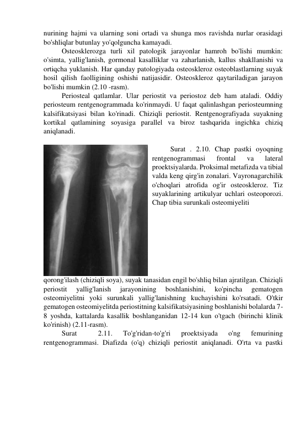 nurining hajmi va ularning soni ortadi va shunga mos ravishda nurlar orasidagi 
bo'shliqlar butunlay yo'qolguncha kamayadi. 
Osteosklerozga turli xil patologik jarayonlar hamroh bo'lishi mumkin: 
o'simta, yallig'lanish, gormonal kasalliklar va zaharlanish, kallus shakllanishi va 
ortiqcha yuklanish. Har qanday patologiyada osteoskleroz osteoblastlarning suyak 
hosil qilish faolligining oshishi natijasidir. Osteoskleroz qaytariladigan jarayon 
bo'lishi mumkin (2.10 -rasm). 
Periosteal qatlamlar. Ular periostit va periostoz deb ham ataladi. Oddiy 
periosteum rentgenogrammada ko'rinmaydi. U faqat qalinlashgan periosteumning 
kalsifikatsiyasi bilan ko'rinadi. Chiziqli periostit. Rentgenografiyada suyakning 
kortikal qatlamining soyasiga parallel va biroz tashqarida ingichka chiziq 
aniqlanadi. 
 
Surat . 2.10. Chap pastki oyoqning 
rentgenogrammasi 
frontal 
va 
lateral 
proektsiyalarda. Proksimal metafizda va tibial 
valda keng qirg'in zonalari. Vayronagarchilik 
o'choqlari atrofida og'ir osteoskleroz. Tiz 
suyaklarining artikulyar uchlari osteoporozi. 
Chap tibia surunkali osteomiyeliti 
 
qorong'ilash (chiziqli soya), suyak tanasidan engil bo'shliq bilan ajratilgan. Chiziqli 
periostit 
yallig'lanish 
jarayonining 
boshlanishini, 
ko'pincha 
gematogen 
osteomiyelitni yoki surunkali yallig'lanishning kuchayishini ko'rsatadi. O'tkir 
gematogen osteomiyelitda periostitning kalsifikatsiyasining boshlanishi bolalarda 7-
8 yoshda, kattalarda kasallik boshlanganidan 12-14 kun o'tgach (birinchi klinik 
ko'rinish) (2.11-rasm). 
Surat 
 
2.11. 
To'g'ridan-to'g'ri 
proektsiyada 
o'ng 
femurining 
rentgenogrammasi. Diafizda (o'q) chiziqli periostit aniqlanadi. O'rta va pastki 
