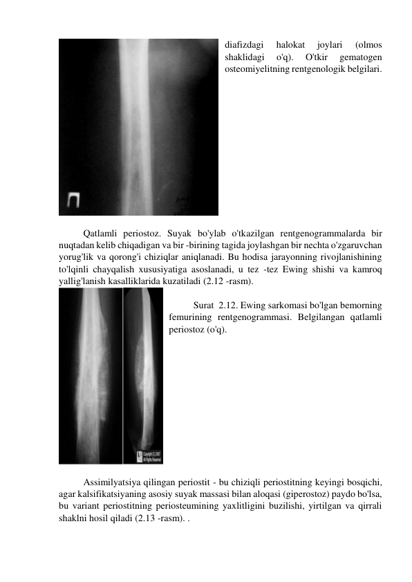 diafizdagi 
halokat 
joylari 
(olmos 
shaklidagi 
o'q). 
O'tkir 
gematogen 
osteomiyelitning rentgenologik belgilari. 
 
 
Qatlamli periostoz. Suyak bo'ylab o'tkazilgan rentgenogrammalarda bir 
nuqtadan kelib chiqadigan va bir -birining tagida joylashgan bir nechta o'zgaruvchan 
yorug'lik va qorong'i chiziqlar aniqlanadi. Bu hodisa jarayonning rivojlanishining 
to'lqinli chayqalish xususiyatiga asoslanadi, u tez -tez Ewing shishi va kamroq 
yallig'lanish kasalliklarida kuzatiladi (2.12 -rasm). 
 
Surat  2.12. Ewing sarkomasi bo'lgan bemorning 
femurining rentgenogrammasi. Belgilangan qatlamli 
periostoz (o'q). 
 
 
Assimilyatsiya qilingan periostit - bu chiziqli periostitning keyingi bosqichi, 
agar kalsifikatsiyaning asosiy suyak massasi bilan aloqasi (giperostoz) paydo bo'lsa, 
bu variant periostitning periosteumining yaxlitligini buzilishi, yirtilgan va qirrali 
shaklni hosil qiladi (2.13 -rasm). . 
