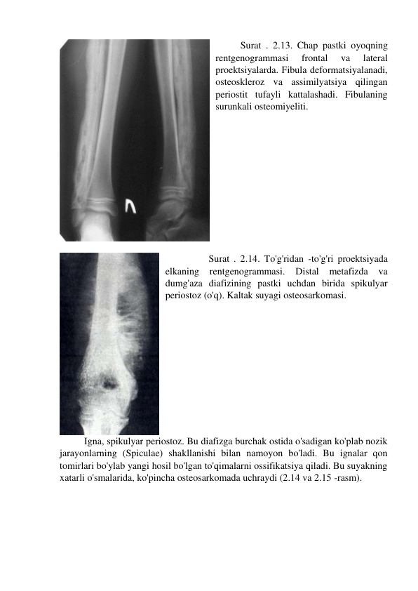 Surat . 2.13. Chap pastki oyoqning 
rentgenogrammasi 
frontal 
va 
lateral 
proektsiyalarda. Fibula deformatsiyalanadi, 
osteoskleroz va assimilyatsiya qilingan 
periostit tufayli kattalashadi. Fibulaning 
surunkali osteomiyeliti. 
 
 
 
Surat . 2.14. To'g'ridan -to'g'ri proektsiyada 
elkaning 
rentgenogrammasi. 
Distal metafizda 
va 
dumg'aza diafizining pastki uchdan birida spikulyar 
periostoz (o'q). Kaltak suyagi osteosarkomasi. 
 
          Igna, spikulyar periostoz. Bu diafizga burchak ostida o'sadigan ko'plab nozik 
jarayonlarning (Spiculae) shakllanishi bilan namoyon bo'ladi. Bu ignalar qon 
tomirlari bo'ylab yangi hosil bo'lgan to'qimalarni ossifikatsiya qiladi. Bu suyakning 
xatarli o'smalarida, ko'pincha osteosarkomada uchraydi (2.14 va 2.15 -rasm). 
