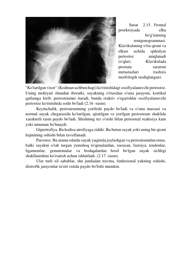  
Surat  2.15. Frontal 
proektsiyada 
elka 
bo'g'imining 
rentgenogrammasi. 
Klavikulaning o'rta qismi va 
elkasi 
uchida 
spikulyar 
periostoz 
aniqlanadi 
(o'qlar). 
Klavikulada 
prostata 
saratoni 
metastazlari 
(tashxis 
morfologik tasdiqlangan). 
 
"Ko'tarilgan visor" (Kodman uchburchagi) ko'rinishidagi ossifiyalanuvchi periostoz. 
Uning mohiyati shundan iboratki, suyakning o'rtasidan o'sma jarayoni, kortikal 
qatlamga kirib, periosteumni itaradi, bunda reaktiv o'zgarishlar ossifiyalanuvchi 
periostoz ko'rinishida sodir bo'ladi (2.16 -rasm). 
Keyinchalik, periosteumning yorilishi paydo bo'ladi va o'sma massasi va 
normal suyak chegarasida ko'tarilgan, ajratilgan va yorilgan periosteum shaklida 
xarakterli rasm paydo bo'ladi. Shishning tez o'sishi bilan periosteal reaktsiya kam 
yoki umuman bo'lmaydi. 
Gipertrofiya. Bu hodisa atrofiyaga ziddir. Bu butun suyak yoki uning bir qismi 
hajmining oshishi bilan tavsiflanadi. 
Parostoz. Bu atama odatda suyak yaqinida joylashgan va periosteumdan emas, 
balki suyakni o'rab turgan yumshoq to'qimalardan, xususan, fastsiya, tendonlar, 
ligamentlar, gematomalar va boshqalardan hosil bo'lgan suyak zichligi 
shakllanishini ko'rsatish uchun ishlatiladi. (2.17 -rasm). 
Ular turli xil sabablar, shu jumladan travma, funktsional yukning oshishi, 
distrofik jarayonlar ta'siri ostida paydo bo'lishi mumkin. 
 
 
 
 
 
 
