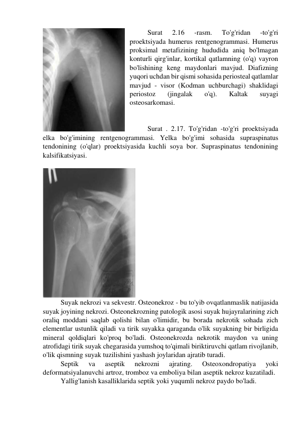 Surat 
2.16 
-rasm. 
To'g'ridan 
-to'g'ri 
proektsiyada humerus rentgenogrammasi. Humerus 
proksimal metafizining hududida aniq bo'lmagan 
konturli qirg'inlar, kortikal qatlamning (o'q) vayron 
bo'lishining keng maydonlari mavjud. Diafizning 
yuqori uchdan bir qismi sohasida periosteal qatlamlar 
mavjud - visor (Kodman uchburchagi) shaklidagi 
periostoz 
(jingalak 
o'q). 
Kaltak 
suyagi 
osteosarkomasi. 
 
 
Surat . 2.17. To'g'ridan -to'g'ri proektsiyada 
elka bo'g'imining rentgenogrammasi. Yelka bo'g'imi sohasida supraspinatus 
tendonining (o'qlar) proektsiyasida kuchli soya bor. Supraspinatus tendonining 
kalsifikatsiyasi. 
 
 
 
Suyak nekrozi va sekvestr. Osteonekroz - bu to'yib ovqatlanmaslik natijasida 
suyak joyining nekrozi. Osteonekrozning patologik asosi suyak hujayralarining zich 
oraliq moddani saqlab qolishi bilan o'limidir, bu borada nekrotik sohada zich 
elementlar ustunlik qiladi va tirik suyakka qaraganda o'lik suyakning bir birligida 
mineral qoldiqlari ko'proq bo'ladi. Osteonekrozda nekrotik maydon va uning 
atrofidagi tirik suyak chegarasida yumshoq to'qimali biriktiruvchi qatlam rivojlanib, 
o'lik qismning suyak tuzilishini yashash joylaridan ajratib turadi. 
Septik 
va 
aseptik 
nekrozni 
ajrating. 
Osteoxondropatiya 
yoki 
deformatsiyalanuvchi artroz, tromboz va emboliya bilan aseptik nekroz kuzatiladi. 
Yallig'lanish kasalliklarida septik yoki yuqumli nekroz paydo bo'ladi. 

