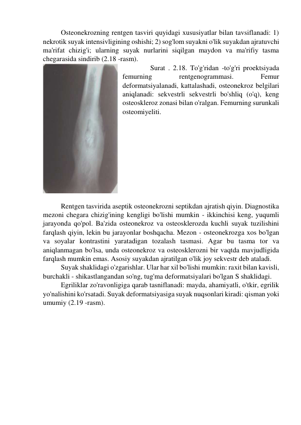 Osteonekrozning rentgen tasviri quyidagi xususiyatlar bilan tavsiflanadi: 1) 
nekrotik suyak intensivligining oshishi; 2) sog'lom suyakni o'lik suyakdan ajratuvchi 
ma'rifat chizig'i; ularning suyak nurlarini siqilgan maydon va ma'rifiy tasma 
chegarasida sindirib (2.18 -rasm). 
 
Surat . 2.18. To'g'ridan -to'g'ri proektsiyada 
femurning 
rentgenogrammasi. 
Femur 
deformatsiyalanadi, kattalashadi, osteonekroz belgilari 
aniqlanadi: sekvestrli sekvestrli bo'shliq (o'q), keng 
osteoskleroz zonasi bilan o'ralgan. Femurning surunkali 
osteomiyeliti. 
 
      
Rentgen tasvirida aseptik osteonekrozni septikdan ajratish qiyin. Diagnostika 
mezoni chegara chizig'ining kengligi bo'lishi mumkin - ikkinchisi keng, yuqumli 
jarayonda qo'pol. Ba'zida osteonekroz va osteosklerozda kuchli suyak tuzilishini 
farqlash qiyin, lekin bu jarayonlar boshqacha. Mezon - osteonekrozga xos bo'lgan 
va soyalar kontrastini yaratadigan tozalash tasmasi. Agar bu tasma tor va 
aniqlanmagan bo'lsa, unda osteonekroz va osteosklerozni bir vaqtda mavjudligida 
farqlash mumkin emas. Asosiy suyakdan ajratilgan o'lik joy sekvestr deb ataladi. 
Suyak shaklidagi o'zgarishlar. Ular har xil bo'lishi mumkin: raxit bilan kavisli, 
burchakli - shikastlangandan so'ng, tug'ma deformatsiyalari bo'lgan S shaklidagi. 
Egriliklar zo'ravonligiga qarab tasniflanadi: mayda, ahamiyatli, o'tkir, egrilik 
yo'nalishini ko'rsatadi. Suyak deformatsiyasiga suyak nuqsonlari kiradi: qisman yoki 
umumiy (2.19 -rasm). 
