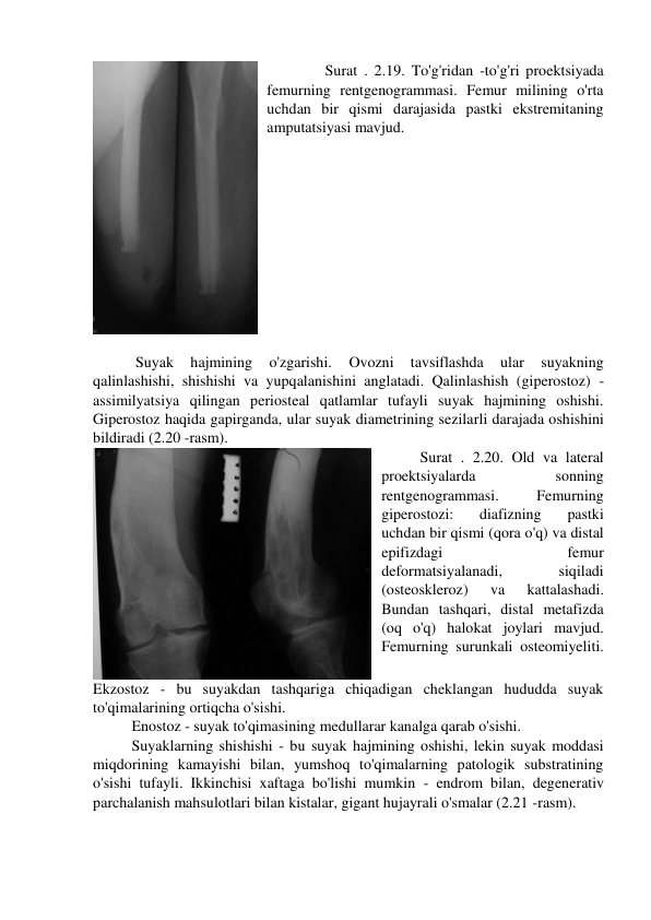  
Surat . 2.19. To'g'ridan -to'g'ri proektsiyada 
femurning rentgenogrammasi. Femur milining o'rta 
uchdan bir qismi darajasida pastki ekstremitaning 
amputatsiyasi mavjud. 
 
     
 Suyak 
hajmining 
o'zgarishi. 
Ovozni 
tavsiflashda 
ular 
suyakning 
qalinlashishi, shishishi va yupqalanishini anglatadi. Qalinlashish (giperostoz) - 
assimilyatsiya qilingan periosteal qatlamlar tufayli suyak hajmining oshishi. 
Giperostoz haqida gapirganda, ular suyak diametrining sezilarli darajada oshishini 
bildiradi (2.20 -rasm). 
Surat . 2.20. Old va lateral 
proektsiyalarda 
sonning 
rentgenogrammasi. 
Femurning 
giperostozi: 
diafizning 
pastki 
uchdan bir qismi (qora o'q) va distal 
epifizdagi 
femur 
deformatsiyalanadi, 
siqiladi 
(osteoskleroz) 
va 
kattalashadi. 
Bundan tashqari, distal metafizda 
(oq o'q) halokat joylari mavjud. 
Femurning surunkali osteomiyeliti. 
Ekzostoz - bu suyakdan tashqariga chiqadigan cheklangan hududda suyak 
to'qimalarining ortiqcha o'sishi. 
Enostoz - suyak to'qimasining medullarar kanalga qarab o'sishi. 
Suyaklarning shishishi - bu suyak hajmining oshishi, lekin suyak moddasi 
miqdorining kamayishi bilan, yumshoq to'qimalarning patologik substratining 
o'sishi tufayli. Ikkinchisi xaftaga bo'lishi mumkin - endrom bilan, degenerativ 
parchalanish mahsulotlari bilan kistalar, gigant hujayrali o'smalar (2.21 -rasm). 
