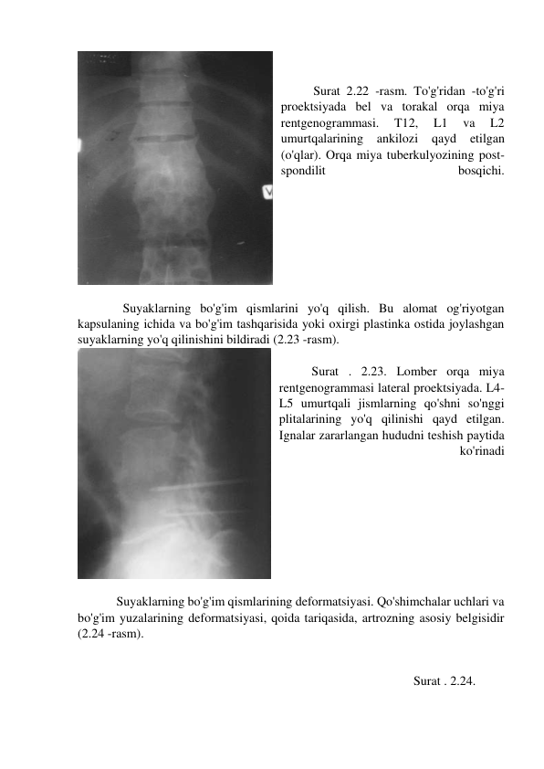 
 
Surat 2.22 -rasm. To'g'ridan -to'g'ri 
proektsiyada bel va torakal orqa miya 
rentgenogrammasi. 
T12, 
L1 
va 
L2 
umurtqalarining 
ankilozi 
qayd 
etilgan 
(o'qlar). Orqa miya tuberkulyozining post-
spondilit 
bosqichi. 
  
    Suyaklarning bo'g'im qismlarini yo'q qilish. Bu alomat og'riyotgan 
kapsulaning ichida va bo'g'im tashqarisida yoki oxirgi plastinka ostida joylashgan 
suyaklarning yo'q qilinishini bildiradi (2.23 -rasm). 
 
Surat . 2.23. Lomber orqa miya 
rentgenogrammasi lateral proektsiyada. L4-
L5 umurtqali jismlarning qo'shni so'nggi 
plitalarining yo'q qilinishi qayd etilgan. 
Ignalar zararlangan hududni teshish paytida 
ko'rinadi 
 
  Suyaklarning bo'g'im qismlarining deformatsiyasi. Qo'shimchalar uchlari va 
bo'g'im yuzalarining deformatsiyasi, qoida tariqasida, artrozning asosiy belgisidir 
(2.24 -rasm). 
 
 
                                                                                               Surat . 2.24. 
