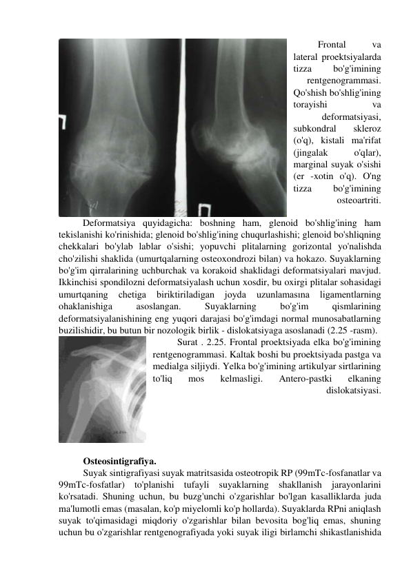 Frontal 
va 
lateral proektsiyalarda 
tizza 
bo'g'imining 
rentgenogrammasi. 
Qo'shish bo'shlig'ining 
torayishi 
va 
deformatsiyasi, 
subkondral 
skleroz 
(o'q), kistali ma'rifat 
(jingalak 
o'qlar), 
marginal suyak o'sishi 
(er -xotin o'q). O'ng 
tizza 
bo'g'imining 
osteoartriti. 
          Deformatsiya quyidagicha: boshning ham, glenoid bo'shlig'ining ham 
tekislanishi ko'rinishida; glenoid bo'shlig'ining chuqurlashishi; glenoid bo'shliqning 
chekkalari bo'ylab lablar o'sishi; yopuvchi plitalarning gorizontal yo'nalishda 
cho'zilishi shaklida (umurtqalarning osteoxondrozi bilan) va hokazo. Suyaklarning 
bo'g'im qirralarining uchburchak va korakoid shaklidagi deformatsiyalari mavjud. 
Ikkinchisi spondilozni deformatsiyalash uchun xosdir, bu oxirgi plitalar sohasidagi 
umurtqaning 
chetiga 
biriktiriladigan 
joyda 
uzunlamasına 
ligamentlarning 
ohaklanishiga 
asoslangan. 
Suyaklarning 
bo'g'im 
qismlarining 
deformatsiyalanishining eng yuqori darajasi bo'g'imdagi normal munosabatlarning 
buzilishidir, bu butun bir nozologik birlik - dislokatsiyaga asoslanadi (2.25 -rasm). 
Surat . 2.25. Frontal proektsiyada elka bo'g'imining 
rentgenogrammasi. Kaltak boshi bu proektsiyada pastga va 
medialga siljiydi. Yelka bo'g'imining artikulyar sirtlarining 
to'liq 
mos 
kelmasligi. 
Antero-pastki 
elkaning 
dislokatsiyasi. 
            
Osteosintigrafiya. 
Suyak sintigrafiyasi suyak matritsasida osteotropik RP (99mTc-fosfanatlar va 
99mTc-fosfatlar) to'planishi tufayli suyaklarning shakllanish jarayonlarini 
ko'rsatadi. Shuning uchun, bu buzg'unchi o'zgarishlar bo'lgan kasalliklarda juda 
ma'lumotli emas (masalan, ko'p miyelomli ko'p hollarda). Suyaklarda RPni aniqlash 
suyak to'qimasidagi miqdoriy o'zgarishlar bilan bevosita bog'liq emas, shuning 
uchun bu o'zgarishlar rentgenografiyada yoki suyak iligi birlamchi shikastlanishida 
