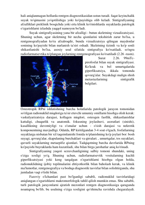 hali aniqlanmagan hollarda rentgen diagnostikasidan ustun turadi. faqat keyinchalik 
suyak to'qimasini yo'qotilishiga yoki ko'payishiga olib keladi. Sintigrafiyaning 
afzalliklari preklinik bosqichda yoki erta klinik ko'rinishlarda suyaklarda patologik 
o'zgarishlarni izlashda yaqqol namoyon bo'ladi. 
Suyak sintigrafiyasining yana bir afzalligi - butun skeletning vizualizatsiyasi. 
Shuning uchun, agar skeletning bir necha qismlarini tekshirish zarur bo'lsa, u 
rentgenografiyadan ko'ra afzalroqdir, bunda vizualizatsiya qilingan maydonlar 
sonining ko'payishi bilan nurlanish ta'siri oshadi. Skeletning tizimli va ko'p sonli 
shikastlanishi bo'lsa, asosiy usul sifatida sintigrafiya ko'rsatiladi, so'ngra 
radiofarmatsevtika to'plangan joylarning rentgenografiyasi ko'rsatiladi (2.26 -rasm). 
 
Surat 
 
2.26. 
99mTc-
pirofosfat bilan suyak sintigrafiyasi. 
Ko'krak 
va 
bel 
umurtqalarida 
giperfiksatsiya, 
ikkala 
tomonda 
qovurg'alar. Suyakdagi malign shish 
metastazlarining 
sintigrafik 
belgilari. 
 
Osteotropik RPni ishlatishning barcha holatlarida patologik jarayon tomonidan 
so'rilgan radionuklid miqdoriga ta'sir etuvchi umumiy omillarni hisobga olish kerak: 
vaskulyarizatsiya darajasi, kollagen miqdori, osteogen faollik, shikastlanishlar 
kattaligi, chuqurlik va anatomik. fokusning joylashuvi, asoratlari (sinishi), 
kasallikning davomiyligi va o'smalar uchun - o'sish darajasi va nekrotik 
komponentning mavjudligi. Odatda, RP kiritilgandan 3-4 soat o'tgach, fosfatlarning 
suyaklarga nisbatan bir xil taqsimlanishi fonida to'planishning ko'p joylari bor: bosh 
suyagi, qovurg'alar, skapulaning burchaklari va qirralari. , umurtqalar, tos suyaklari, 
quvurli suyaklarning metaepifiz qismlari. Tadqiqotning barcha davrlarida RPning 
ko'payishi buyraklarda ham kuzatiladi, shu bilan birga jarohatlar aniq ko'rinadi. 
Sintigrafiyaning yuqori sezuvchanligining salbiy tomoni shundaki, uning 
o'ziga xosligi yo'q. Shuning uchun, radiofarmatsevtik vositalarning kuchli 
giperfiksatsiyasi yoki keng tarqalgan o'zgarishlarni hisobga olgan holda, 
radionuklidning ijobiy topilmalarini ehtiyotkorlik bilan baholash kerak, va klinik 
ma'lumotlar, rentgenografiya va boshqa diagnostik tasvirlar bilan solishtirganda, shu 
jumladan vaqt o'tishi bilan. 
Fazoviy o'lchamlari past bo'lganligi sababli, radionuklid tasvirlaridagi 
aniqlangan o'zgarishlarni makromorfologik tahlil qilish mumkin emas. Shu sababli, 
turli patologik jarayonlarni ajratish mezonlari rentgen diagnostikasiga qaraganda 
noaniqroq bo'lib, bu usulning o'ziga xosligini qo'shimcha ravishda chegaralaydi. 
