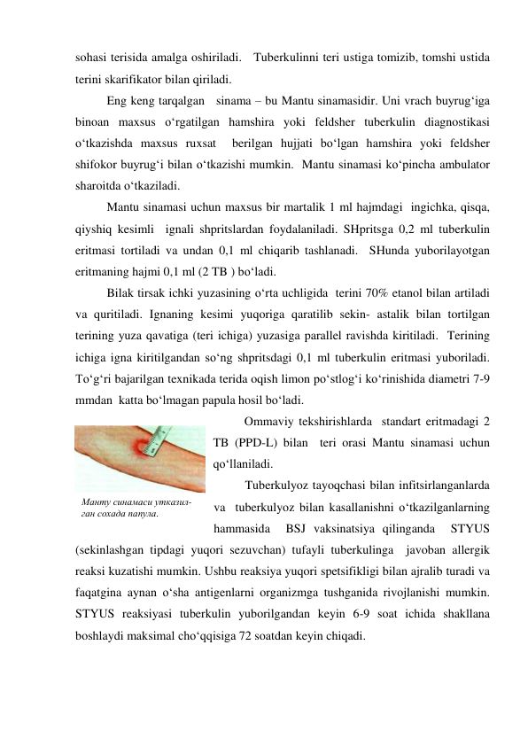 sohasi terisida amalga oshiriladi.   Tuberkulinni teri ustiga tomizib, tomshi ustida 
terini skarifikator bilan qiriladi.   
 
Eng keng tarqalgan   sinama – bu Mantu sinamasidir. Uni vrach buyrug‘iga 
binoan maxsus o‘rgatilgan hamshira yoki feldsher tuberkulin diagnostikasi 
o‘tkazishda maxsus ruxsat  berilgan hujjati bo‘lgan hamshira yoki feldsher 
shifokor buyrug‘i bilan o‘tkazishi mumkin.  Mantu sinamasi ko‘pincha ambulator 
sharoitda o‘tkaziladi.  
  
Mantu sinamasi uchun maxsus bir martalik 1 ml hajmdagi  ingichka, qisqa,   
qiyshiq kesimli  ignali shpritslardan foydalaniladi. SHpritsga 0,2 ml tuberkulin 
eritmasi tortiladi va undan 0,1 ml chiqarib tashlanadi.  SHunda yuborilayotgan 
eritmaning hajmi 0,1 ml (2 TB ) bo‘ladi.   
 
Bilak tirsak ichki yuzasining o‘rta uchligida  terini 70% etanol bilan artiladi 
va quritiladi. Ignaning kesimi yuqoriga qaratilib sekin- astalik bilan tortilgan 
terining yuza qavatiga (teri ichiga) yuzasiga parallel ravishda kiritiladi.  Terining 
ichiga igna kiritilgandan so‘ng shpritsdagi 0,1 ml tuberkulin eritmasi yuboriladi.  
To‘g‘ri bajarilgan texnikada terida oqish limon po‘stlog‘i ko‘rinishida diametri 7-9 
mmdan  katta bo‘lmagan papula hosil bo‘ladi. 
 
Ommaviy tekshirishlarda  standart eritmadagi 2 
TB (PPD-L) bilan  teri orasi Mantu sinamasi uchun  
qo‘llaniladi.  
 
Tuberkulyoz tayoqchasi bilan infitsirlanganlarda 
va  tuberkulyoz bilan kasallanishni o‘tkazilganlarning 
hammasida  BSJ vaksinatsiya qilinganda  STYUS 
(sekinlashgan tipdagi yuqori sezuvchan) tufayli tuberkulinga  javoban allergik 
reaksi kuzatishi mumkin. Ushbu reaksiya yuqori spetsifikligi bilan ajralib turadi va 
faqatgina aynan o‘sha antigenlarni organizmga tushganida rivojlanishi mumkin.  
STYUS reaksiyasi tuberkulin yuborilgandan keyin 6-9 soat ichida shakllana 
boshlaydi maksimal cho‘qqisiga 72 soatdan keyin chiqadi. 
Манту синамаси утказил-
ган сохада папула. 
