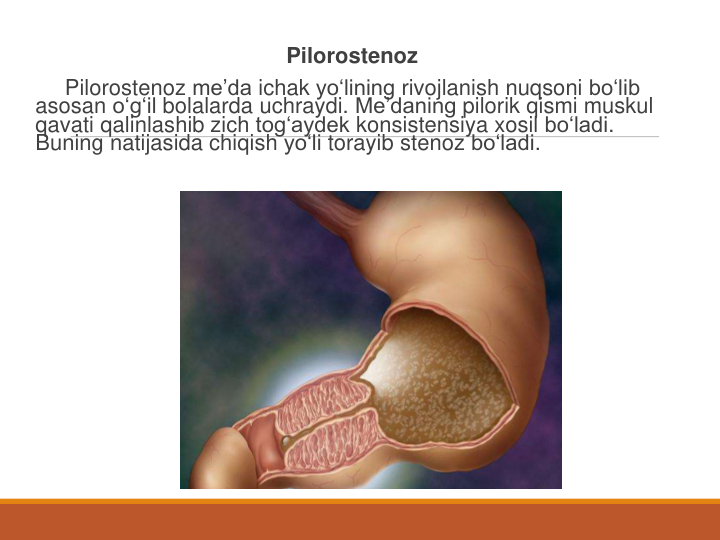 Pilorostenoz
Pilorostenoz me’da ichak yo‘lining rivojlanish nuqsoni bo‘lib
asosan o‘g‘il bolalarda uchraydi. Me’daning pilorik qismi muskul
qavati qalinlashib zich tog‘aydek konsistensiya xosil bo‘ladi. 
Buning natijasida chiqish yo‘li torayib stenoz bo‘ladi.
