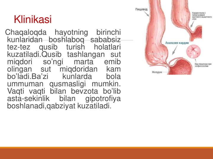 Klinikasi
Chaqaloqda
hayotning
birinchi
kunlaridan boshlaboq sababsiz
tez-tez
qusib
turish
holatlari
kuzatiladi.Qusib tashlangan sut
miqdori
so’ngi
marta
emib
olingan
sut
miqdoridan
kam
bo’ladi.Ba’zi
kunlarda
bola
ummuman qusmasligi mumkin.
Vaqti vaqti bilan bevzota bo’lib
asta-sekinlik
bilan
gipotrofiya
boshlanadi,qabziyat kuzatiladi.
