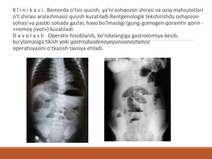 K l i n i k a s i . Bemorda o‘tsiz qusish, ya’ni oshqozon shirasi va oziq mahsulotlari 
o‘t shirasi aralashmasiz qusish kuzatiladi.Rentgenologik tekshirishda oshqozon 
sohasi va pastki sohada gazlar, havo bo‘lmasligi (gung-gomogen qoramtir qorin -
«nemoy jivot») kuzatiladi.
D a v o l a s h . Operativ hisoblanib, ko‘ndalangiga gastrotomiya-kesib, 
bo‘ylamasiga tikish yoki gastroduodenoyeyunoanastamoz
operatsiyasini o‘tkazish tavsiya etiladi. 
